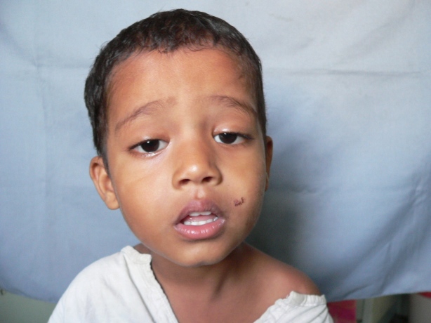 A case of congenital ptosis with total absence of movement of the eyelid due to a dysplastic or an undeveloped LPS. This is ideally suited for a frontalis  facial sling anchored to the tarsus. The child is old enough to be trained to convert his frontalis action for opening the eyelids. Please see table for choice of operation in an earlier part of this chapter (after Berke). See figure 9.