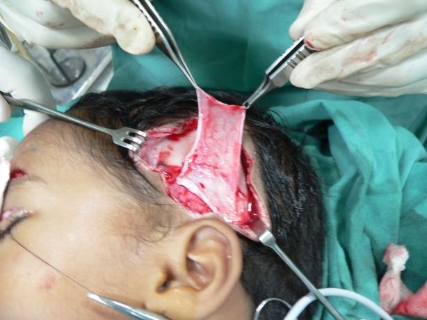The temporal fascia is being harvested. Adequate breadth and length of this tissue will allow its use for both sides.